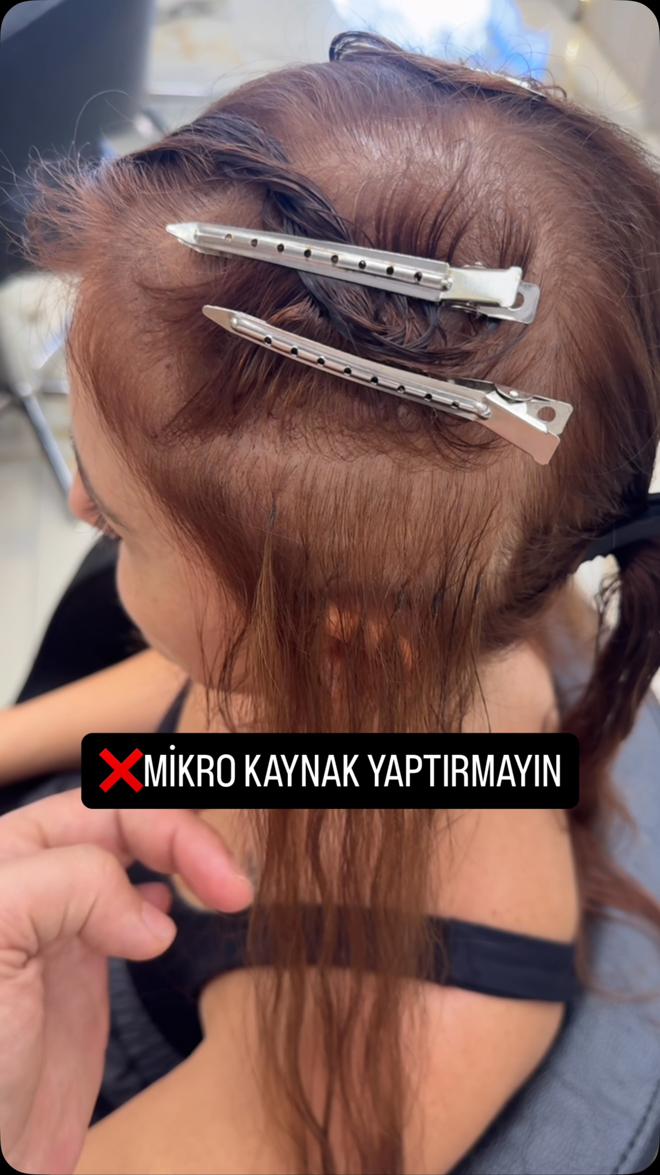 Saç Söküm (Kaynak Çıkarma)